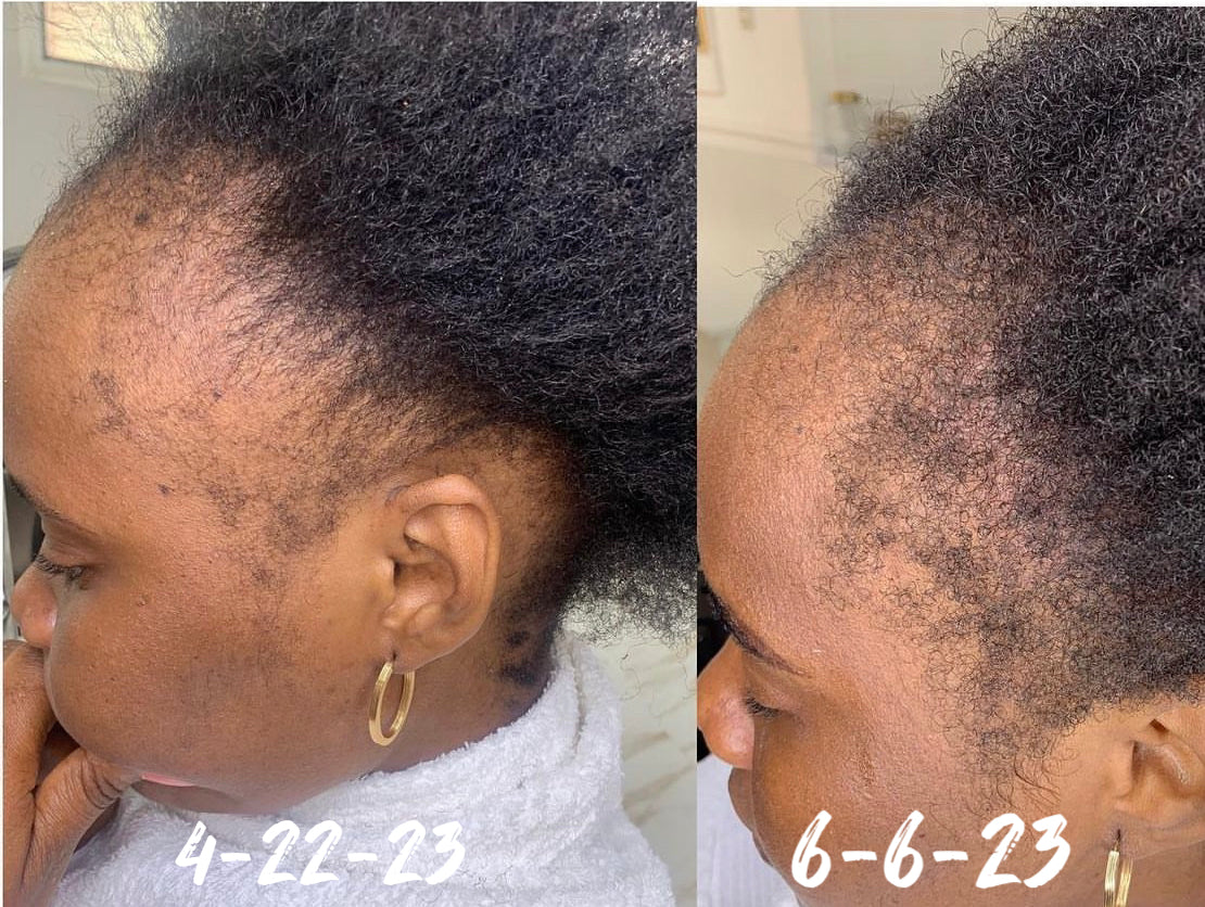 Ayurvedic Alopecia Hair Oil