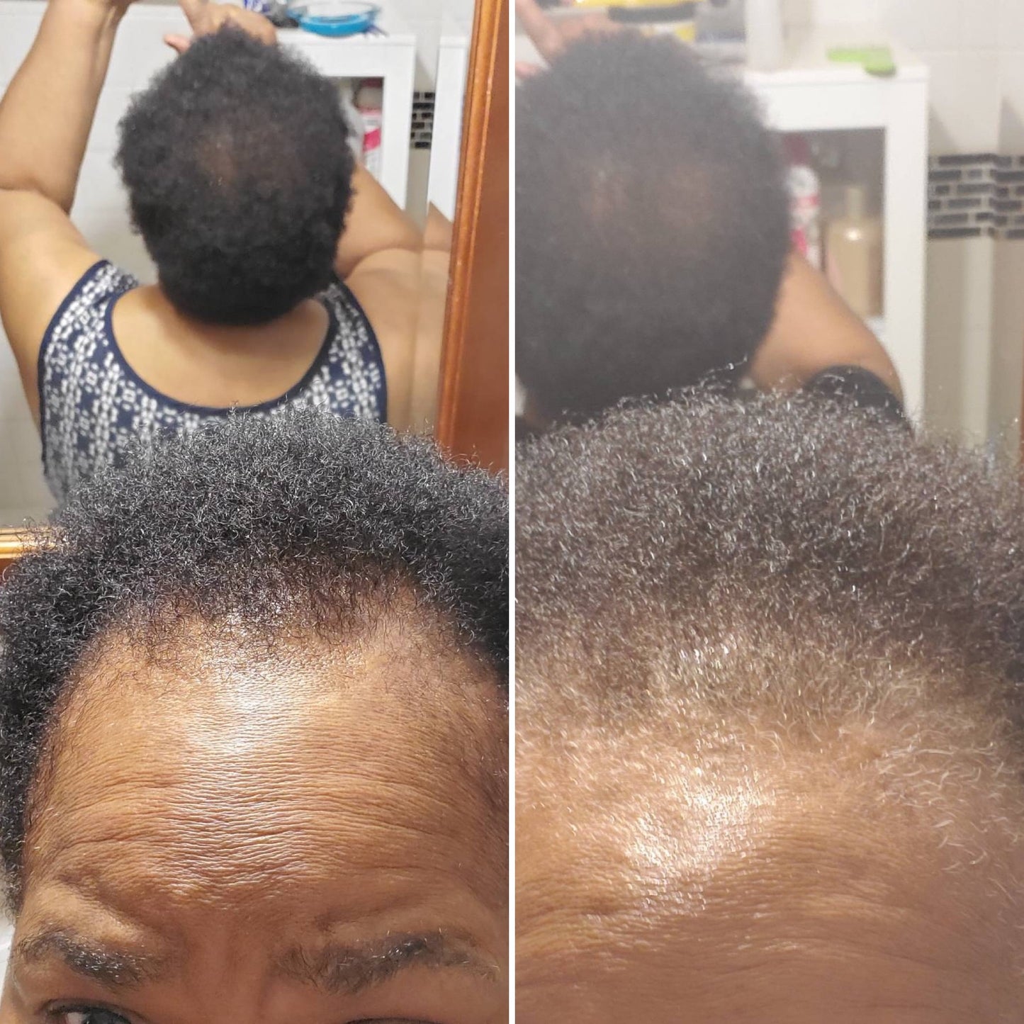 Ayurvedic Alopecia Hair Oil