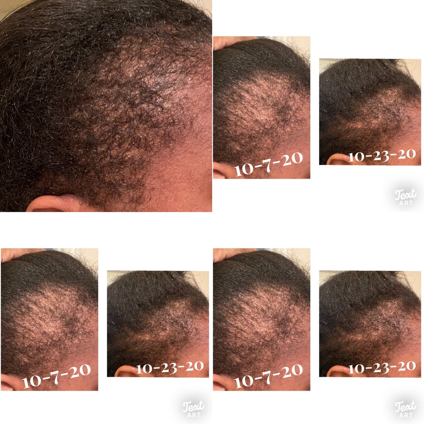 Ayurvedic Alopecia Hair Oil