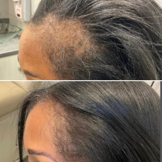 Ayurvedic Alopecia Hair Oil